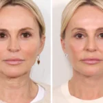 Boost Collagen Naturally Using Thread lift treatment in Dubai Techniques Today