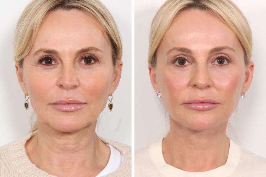 Boost Collagen Naturally Using Thread lift treatment in Dubai Techniques Today