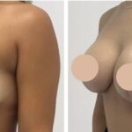 H2-Breast-Lift