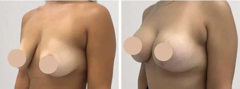 H2-Breast-Lift