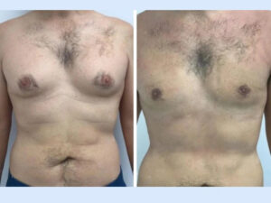 H4-Gynecomastia
