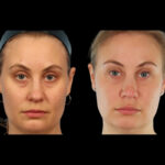 under eye fillers