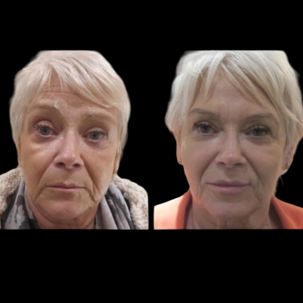 Jawline Fillers in Dubai