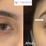 How to Fix Sunken Eyes With Fillers