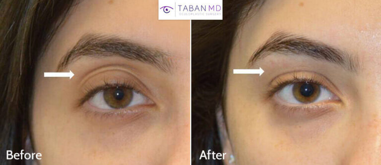 How to Fix Sunken Eyes With Fillers