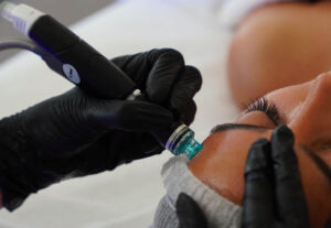Hydrafacial for Acne-Prone Skin