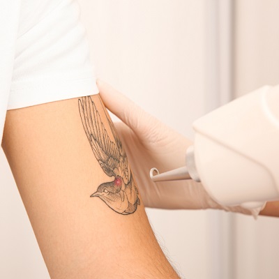 Laser Tattoo Removal in Islamabad