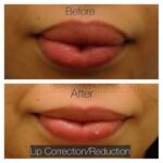 Lip Reduction in Islamabad