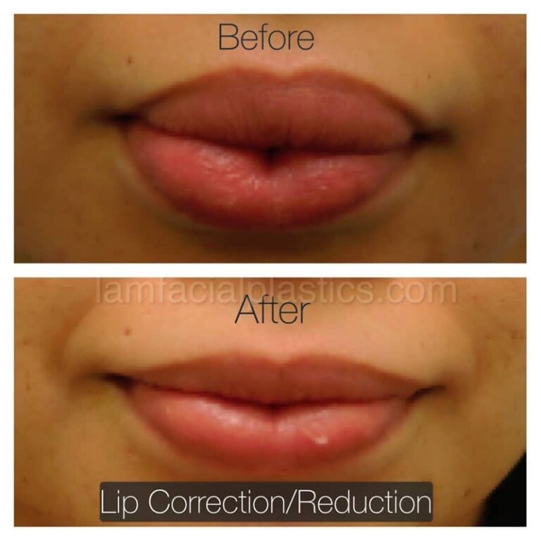 Lip Reduction in Islamabad