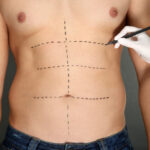 Liposuction Riyadh