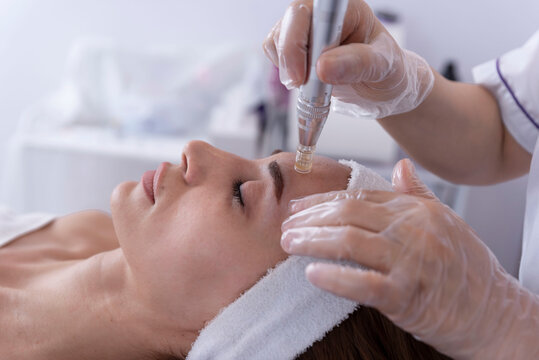 Microneedling Treatment in Islamabad