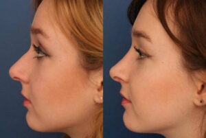 How Much Does Non-Surgical Rhinoplasty Cost