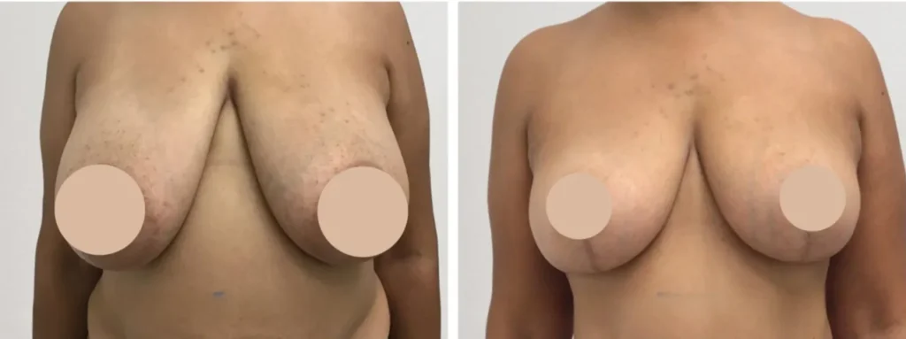 breast reduction p