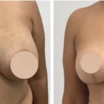 breast reduction p