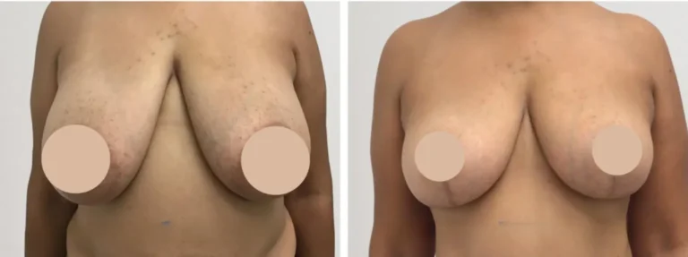breast reduction p
