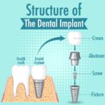 dentalimplants-1