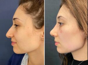 Fat Grafting in Dubai