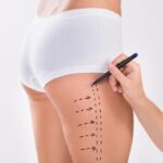 vaser liposuction in dubai