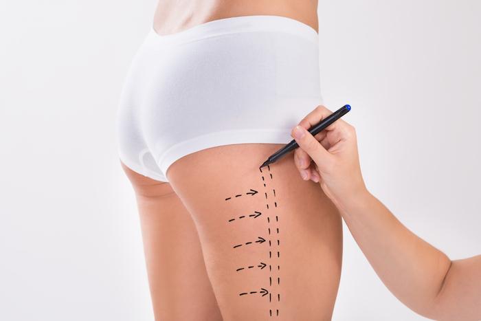 vaser liposuction in dubai