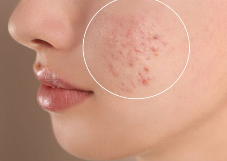 scar-removal-treatment-dubai.png