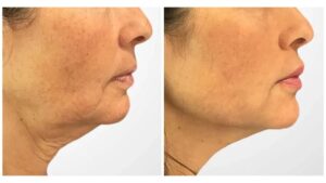 Thread Lift in Dubai Enhances Facial Contours With Precision Based Techniques