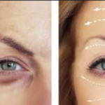 3 areas of botox before and after