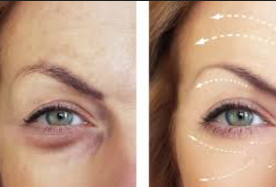 3 areas of botox before and after