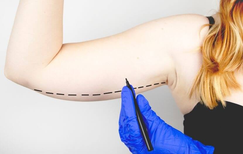 Arm Lift Surgery in Riyadh