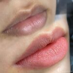 Best Lip Pigmentation Removal in Islamabad