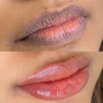 Best Lip Pigmentation Removal in Islamabad & Rawalpindi