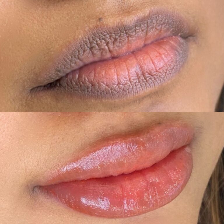 Best Lip Pigmentation Removal in Islamabad & Rawalpindi