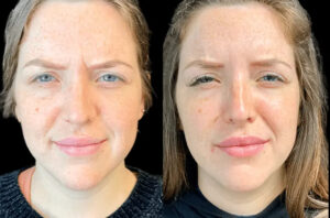 Best Plastic Surgeons in Dubai for Crow’s Feet