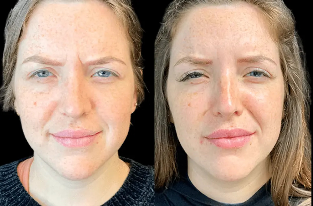 Best Plastic Surgeons in Dubai for Crow’s Feet