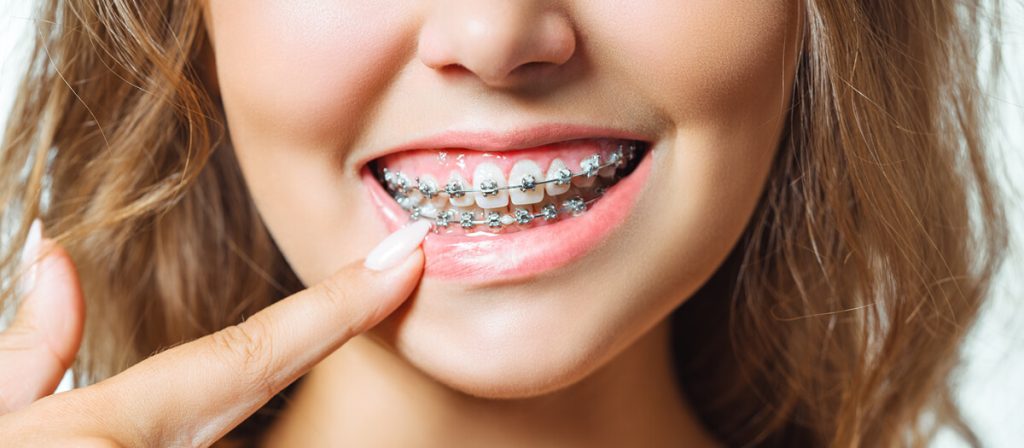 Dental Braces in Islamabad