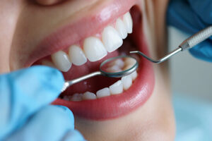 Dental Filling in Islamabad