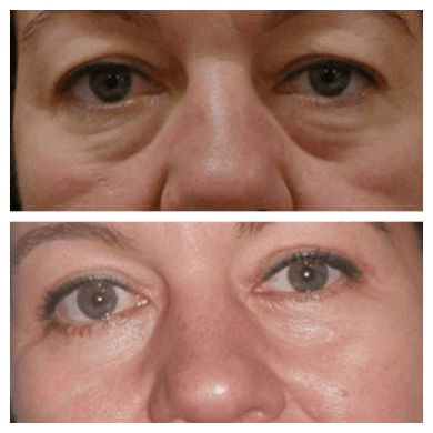 Eye bag Removal in Dubai