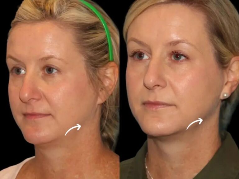 sculptra fillers in dubai
