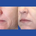 Fractional Radiofrequency (RF) Microneedling Treatment in Dubai
