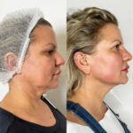 Endolift for Anti-Aging Solutions by Best Plastic Surgeon in Dubai
