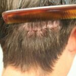 Hair Transplant in Riyadh