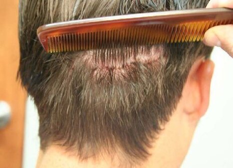 Hair Transplant in Riyadh