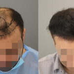 Hair Transplant in Riyadh.