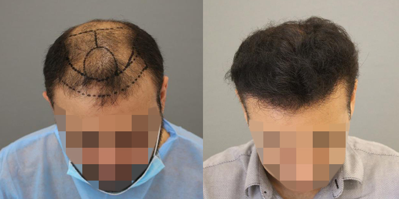 Hair Transplant in Riyadh.