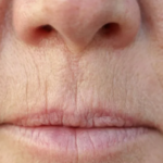 How to get rid of smoker lines