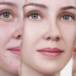 Laser Treatment for Acne Scars Cost in Islamabad