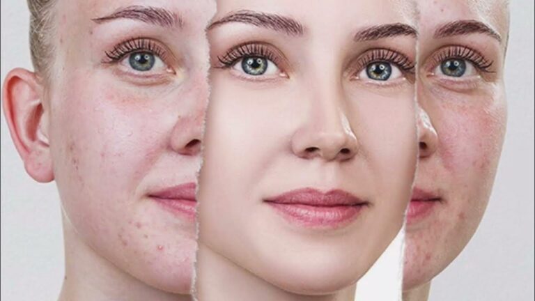 Laser Treatment for Acne Scars Cost in Islamabad