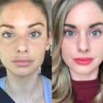 Radiofrequency Microneedling Dubai,