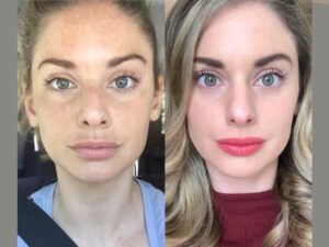 Radiofrequency Microneedling Dubai,