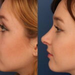 How Much Does Non-Surgical Rhinoplasty Cost
