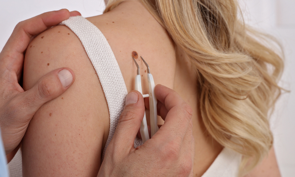 Wart Removal – Restore Smooth and Healthy Skin